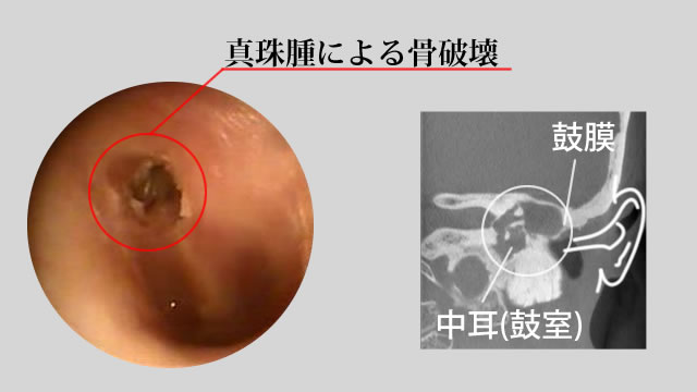 真珠腫により骨破壊が起こっている状況