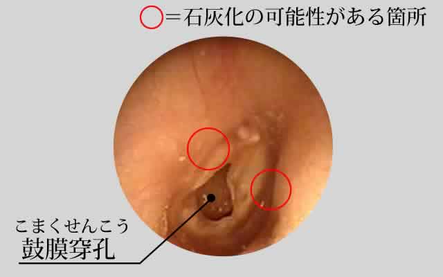 慢性中耳炎(鼓室硬化症)の例