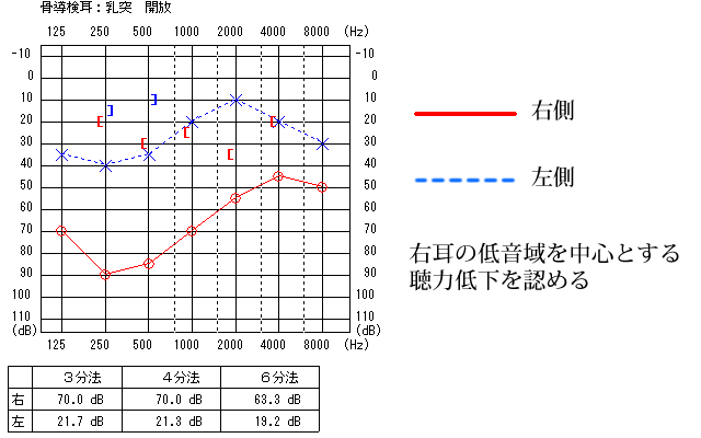 聴力検査－鼓室硬化症の例