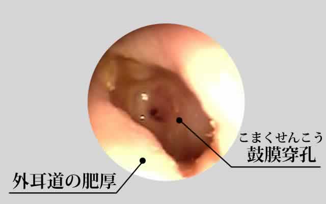 慢性化膿性中耳炎の例