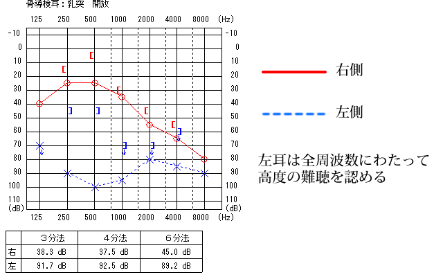 聴力検査－慢性化膿性中耳炎の例