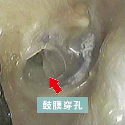 慢性中耳炎