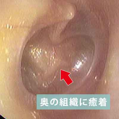 癒着性中耳炎