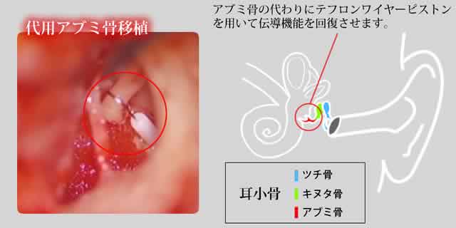 代用アブミ骨移植