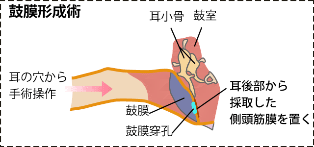 鼓膜形成術