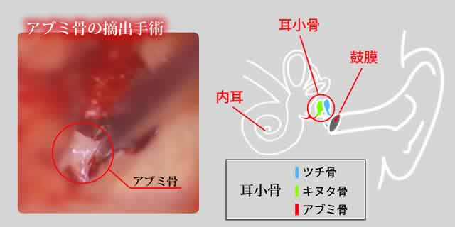 アブミ骨の摘出手術