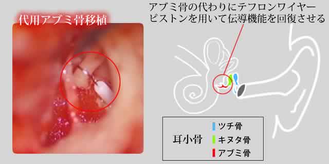 代用アブミ骨移植