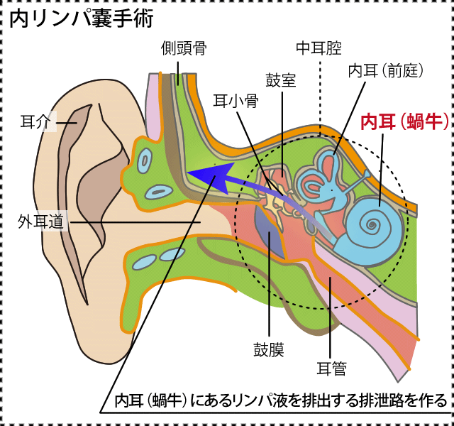 内リンパ嚢手術