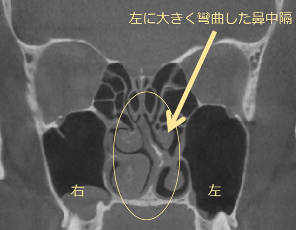 鼻中弯曲症説明写真