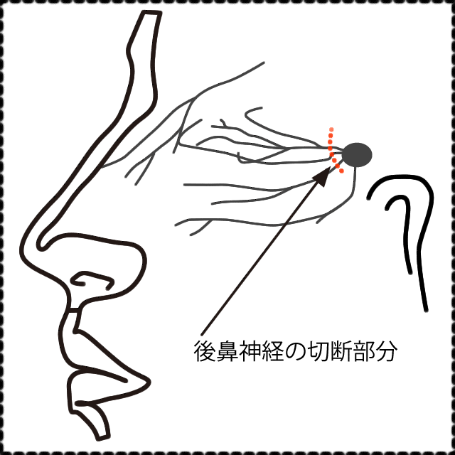 後鼻神経切断術