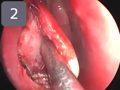 粘膜下下鼻甲介骨切除術2