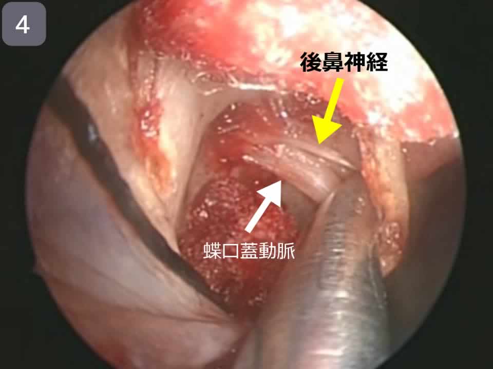 後鼻神経切断術1