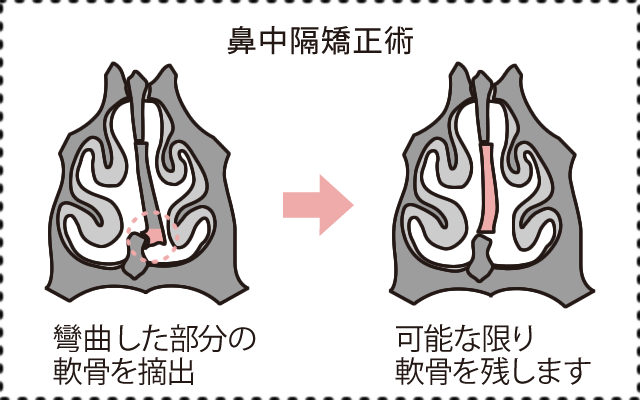 鼻中隔矯正術