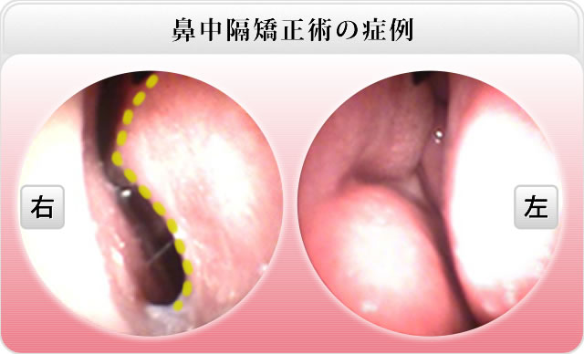 鼻中隔矯正前