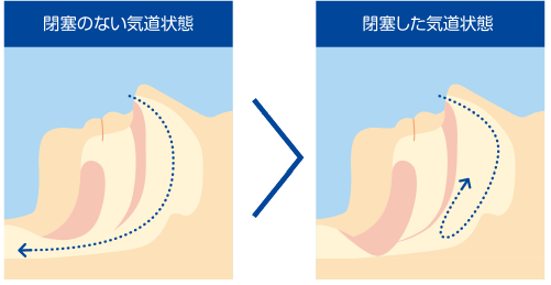 閉塞のない気道状態と閉塞した気道状態