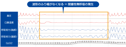 波形のふり幅がなくなる＝閉塞性無呼吸の発生
