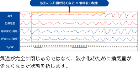 波形のふり幅が弱くなる＝低呼吸の発生
気道が完全に閉じるのではなく、狭小化のために換気量が少なくなった状態を指します。
