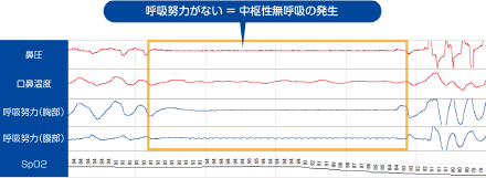 呼吸努力がない＝中枢性無呼吸の発生