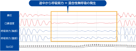 途中から呼吸努力＝混合性無呼吸の発生