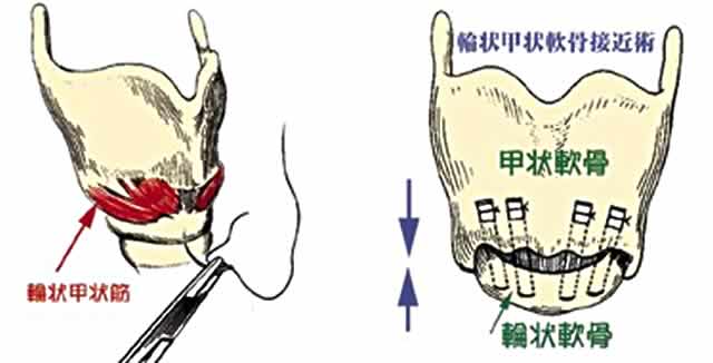 甲状軟骨形成術Ⅳ型