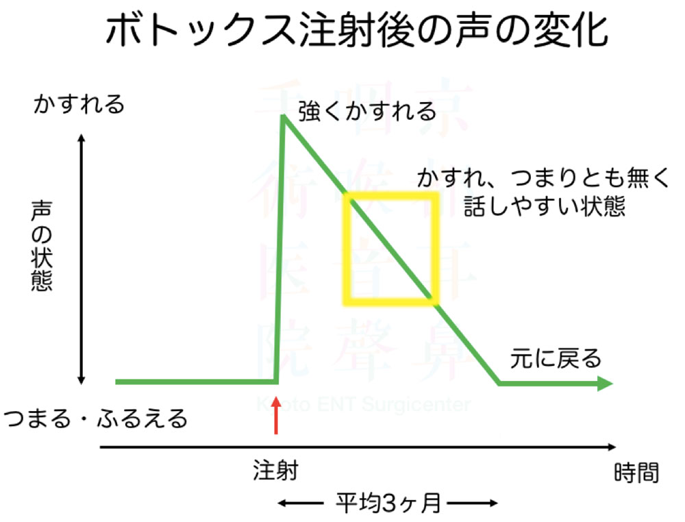 ボトックス注射後の声の変化